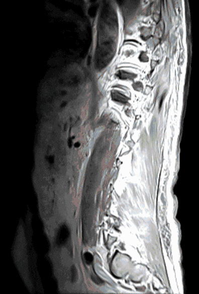 Metastasen_Rueckenmark Metastasen_Rueckenmark